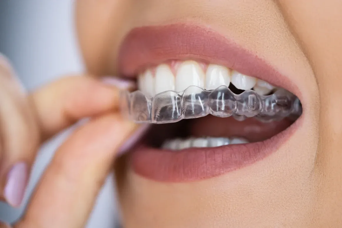 Pose d'un aligneur transparent en orthodontie adulte