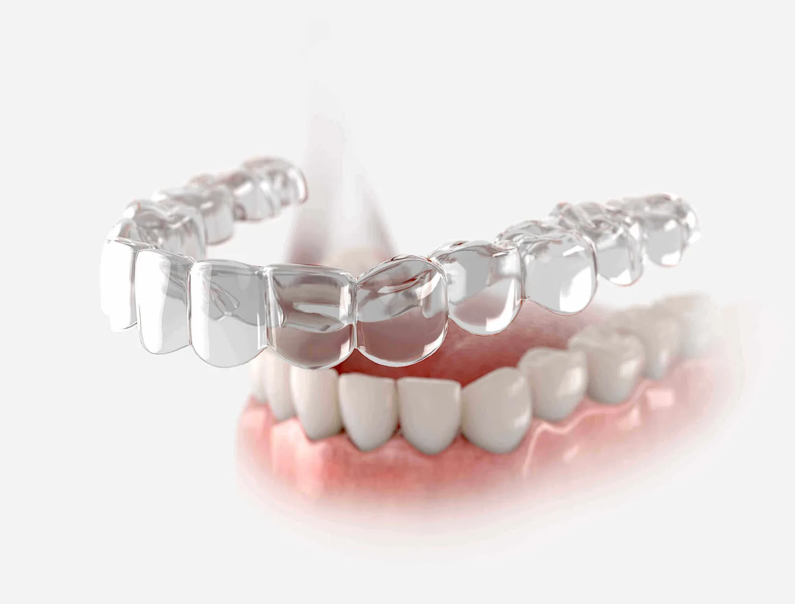 Aligneurs transparents pour traitement orthodontique discret