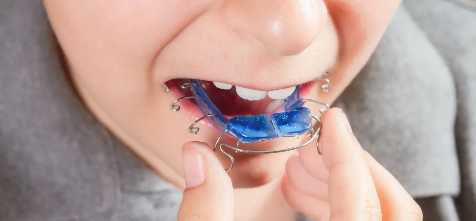 Appareil orthodontique amovible avec base palatine en résine