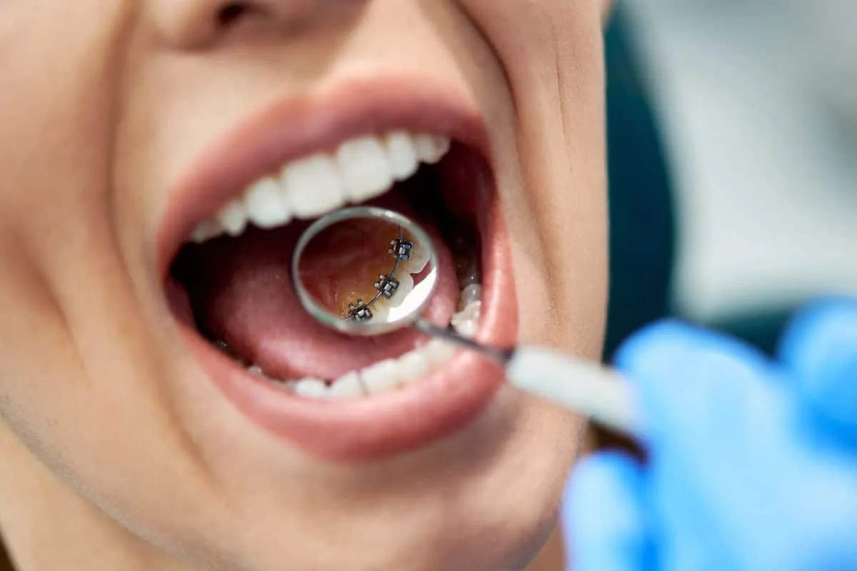 Bagues linguales sur la face interne des dents